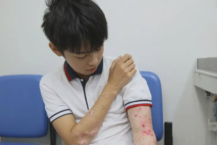 中学生四肢出现湿疹能彻底自愈吗(图4)