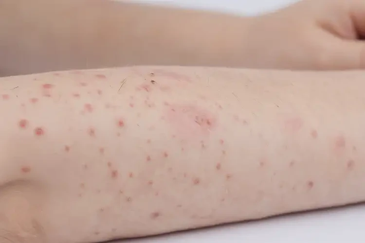 青少年屁股上起濕疹可以徹底自愈嗎(圖4)