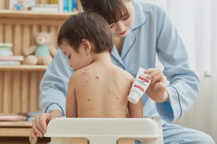 孩子四肢出現(xiàn)濕疹可不可以徹底自愈(圖2)