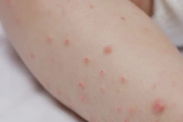 嬰幼兒小腿容易長(zhǎng)濕疹可以徹底自愈嗎(圖4)