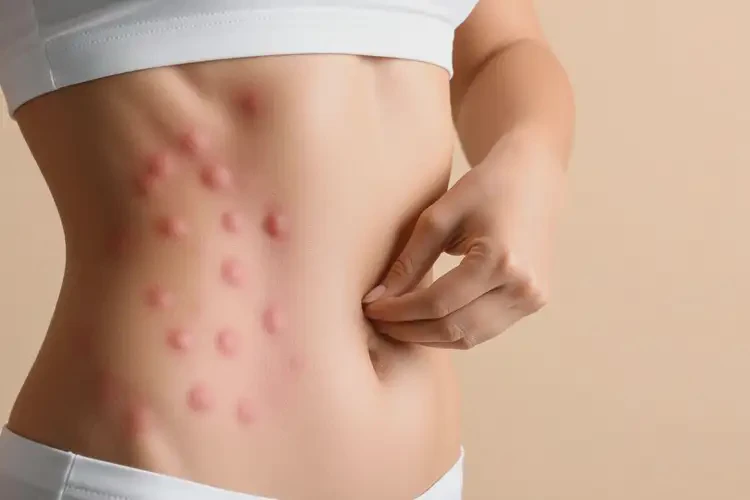 青年人肚子容易長(zhǎng)濕疹能徹底自愈嗎(圖3)