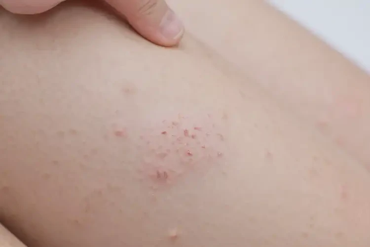 小孩大腿出現(xiàn)濕疹能靠自己自愈嗎(圖4)