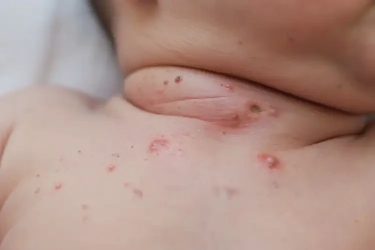 新生兒脖子上有濕疹能夠徹底治愈嗎(圖4)