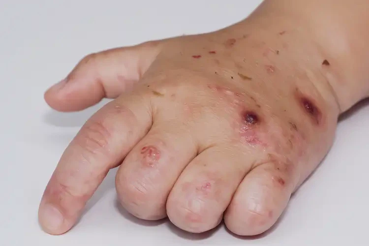 小孩手上偶爾長濕疹不管它會自己好嗎(圖3)