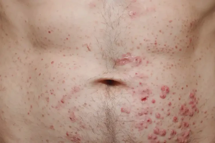 男性肚子容易起濕疹能徹底自愈嗎(圖4)