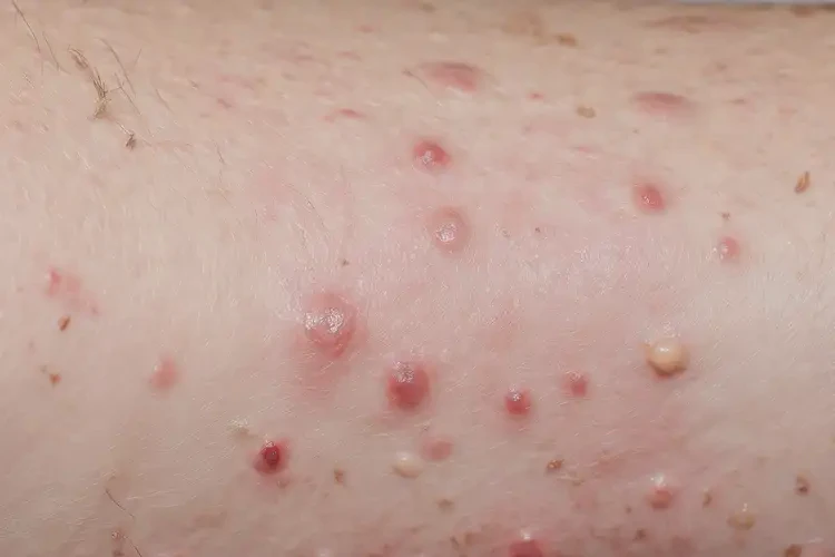 大學(xué)生屁股上起濕疹不管它會自己痊愈嗎(圖4)