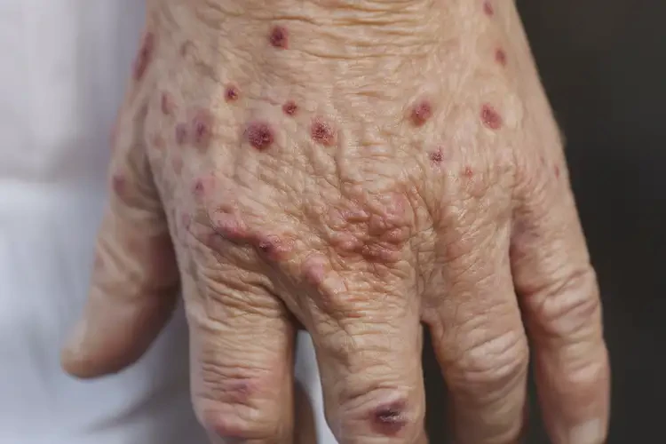 老年人手上出濕疹不管它會(huì)自己痊愈嗎(圖4)