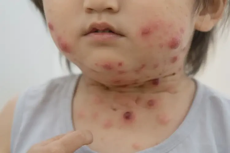 小兒脖子經(jīng)常起濕疹不管它會(huì)自己痊愈嗎(圖4)