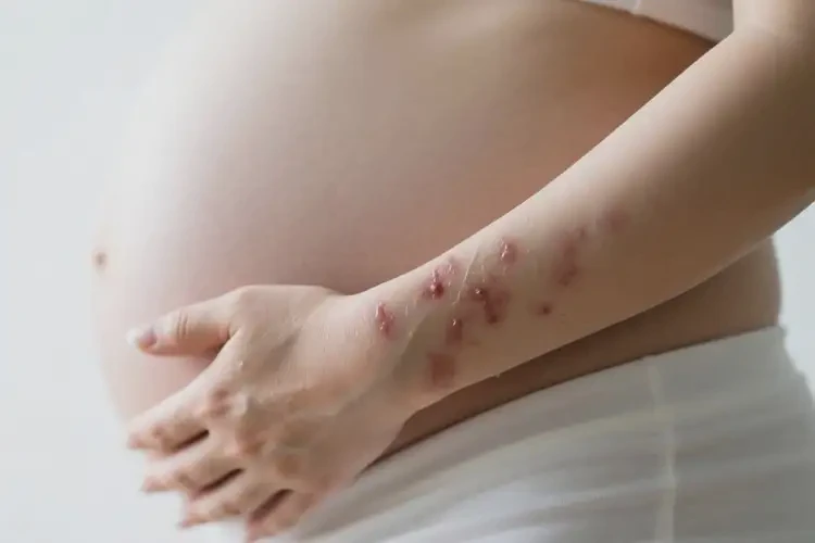 孕妇手臂上起湿疹可不可以彻底自愈(图1)