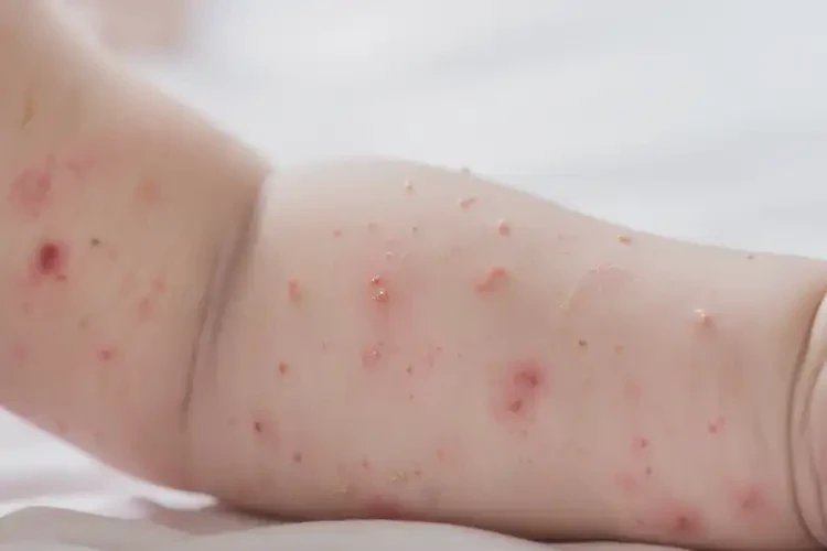 宝宝手臂容易长湿疹能靠自己自愈吗(图4)