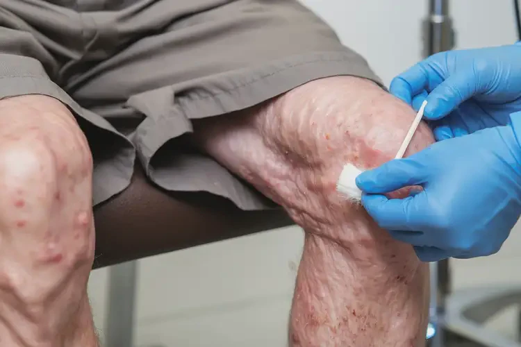 老年人小腿上偶爾起濕疹不管它會(huì)自己痊愈嗎(圖4)