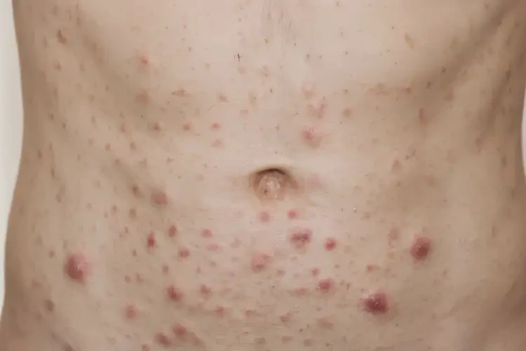 青年人肚子上長(zhǎng)濕疹不管它會(huì)自己痊愈嗎(圖4)