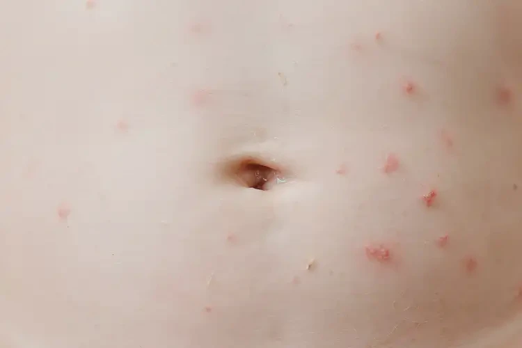 小孩肚子上容易起湿疹不管它会自己痊愈吗(图4)