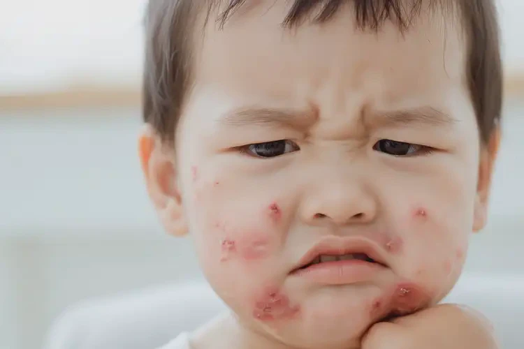 幼兒面部出現(xiàn)濕疹不管它會(huì)自己痊愈嗎(圖4)