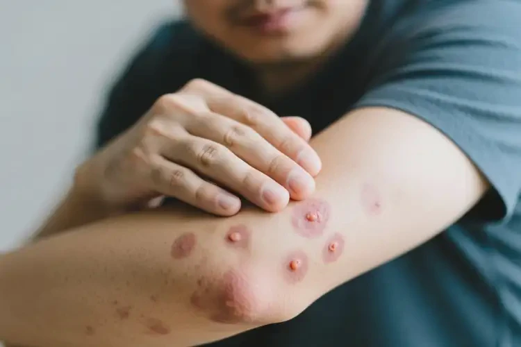 男性手臂起濕疹不管它會(huì)自己好嗎(圖2)