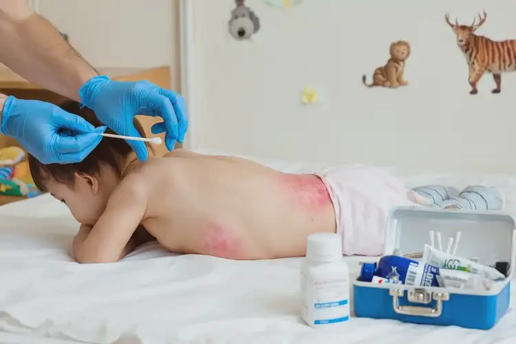 幼兒肛周出現(xiàn)濕疹能靠自己自愈嗎(圖4)