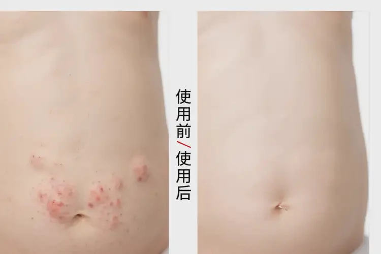 小孩肚子上容易起湿疹不管它会自己痊愈吗(图2)