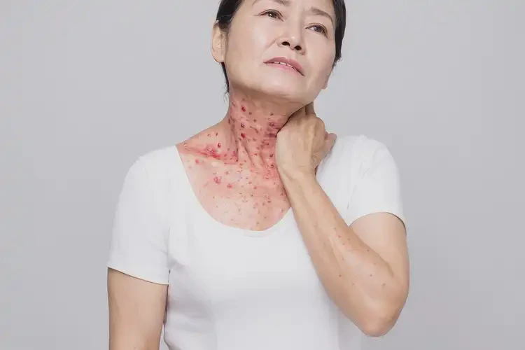 女生脖子偶爾起濕疹不管它會(huì)自己自愈嗎(圖3)