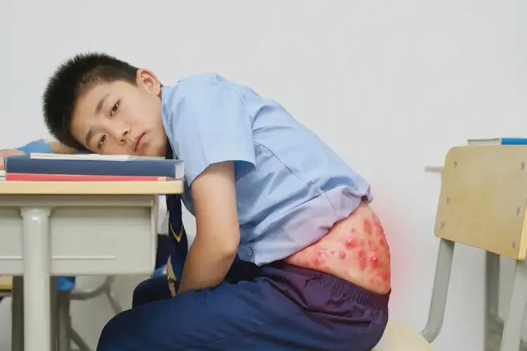 中學(xué)生屁股上容易起濕疹不管它會自己痊愈嗎(圖4)