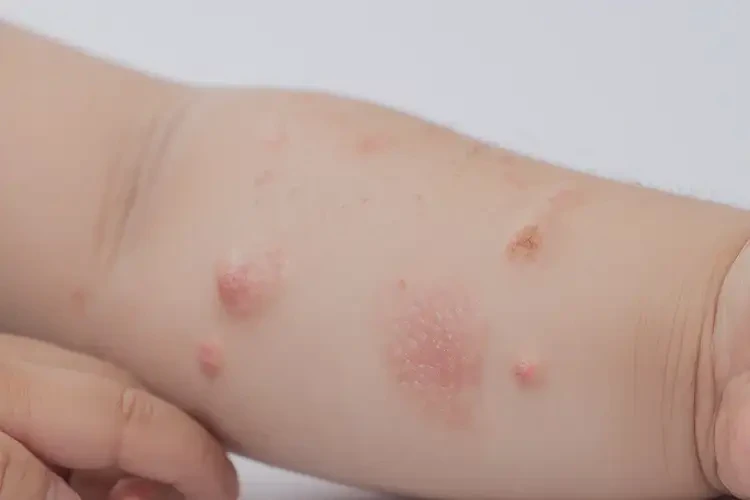兒童手臂上長濕疹能徹底自愈嗎(圖4)