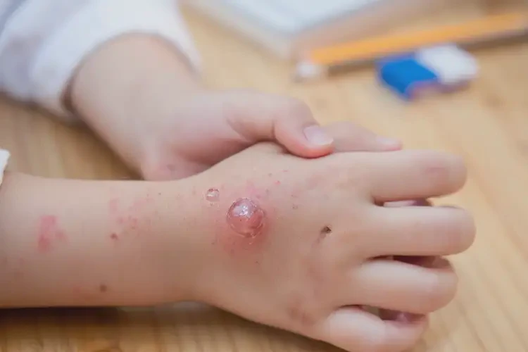 小學(xué)生手上容易起濕疹能靠自己自愈嗎(圖4)