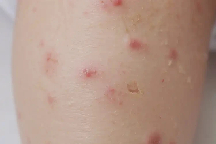 幼兒小腿上出現(xiàn)濕疹不管它會(huì)自己好嗎(圖4)