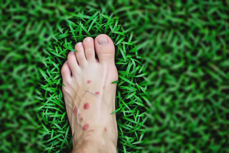 男性腳上偶爾長濕疹能徹底自愈嗎(圖2)