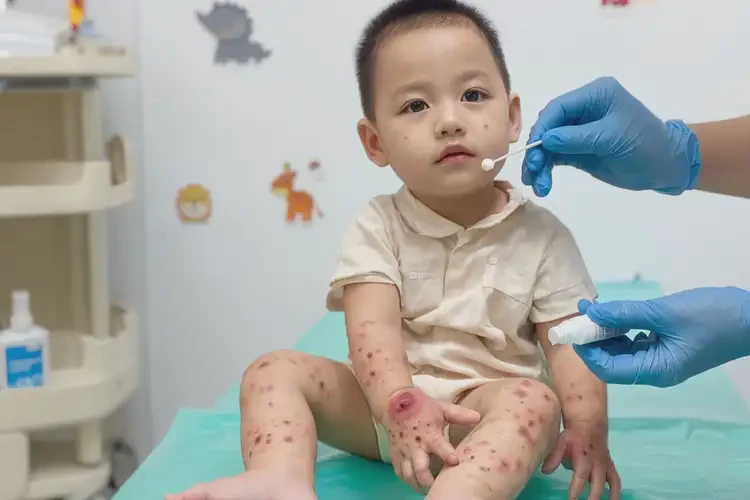 幼兒全身經(jīng)常起濕疹能夠徹底治愈嗎(圖3)