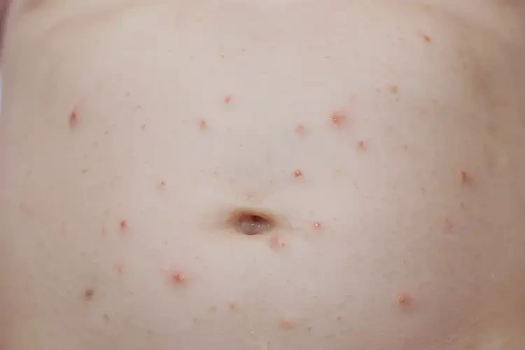 少兒肚子起濕疹不管它會自己痊愈嗎(圖4)