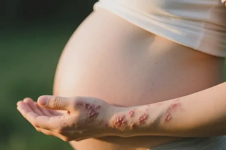 產(chǎn)婦手臂上長濕疹能靠自己自愈嗎(圖1)