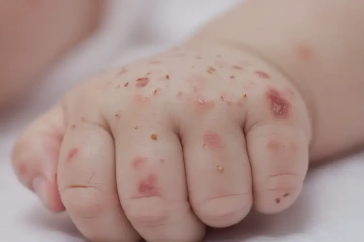 嬰兒手上起濕疹可以徹底自愈嗎(圖4)