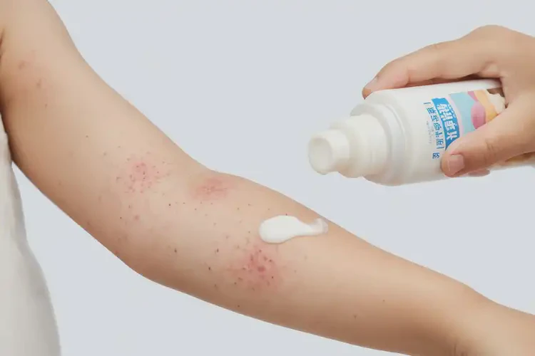 孩子手臂起濕疹不管它會(huì)自己自愈嗎(圖2)