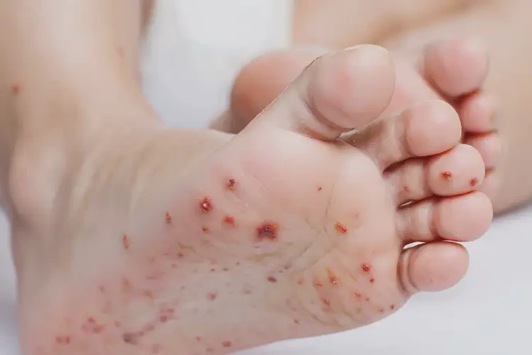 孩子腳上出現(xiàn)濕疹不管它會自己痊愈嗎(圖4)