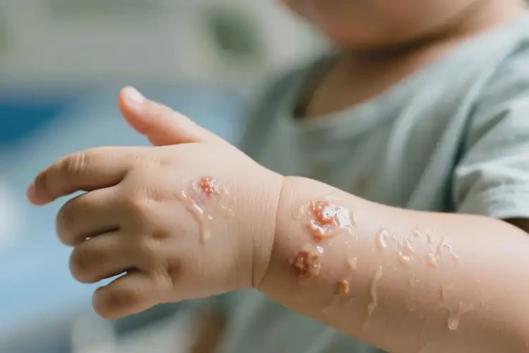 小孩手臂出濕疹能靠自己自愈嗎(圖3)