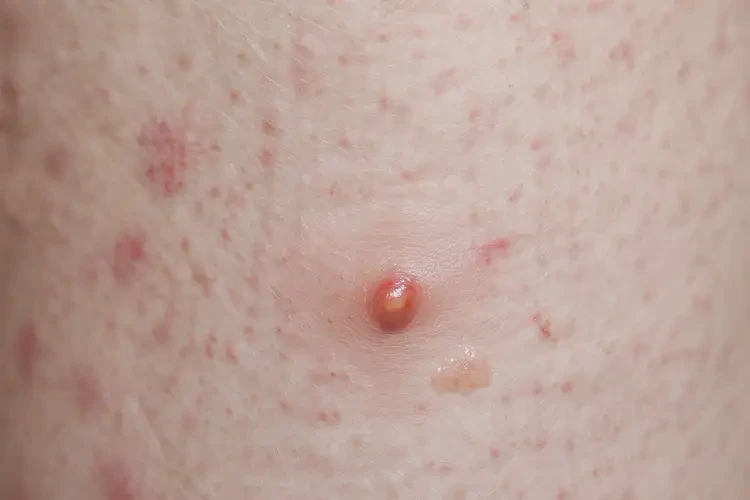 小兒肛周經(jīng)常起濕疹能徹底自愈嗎(圖4)