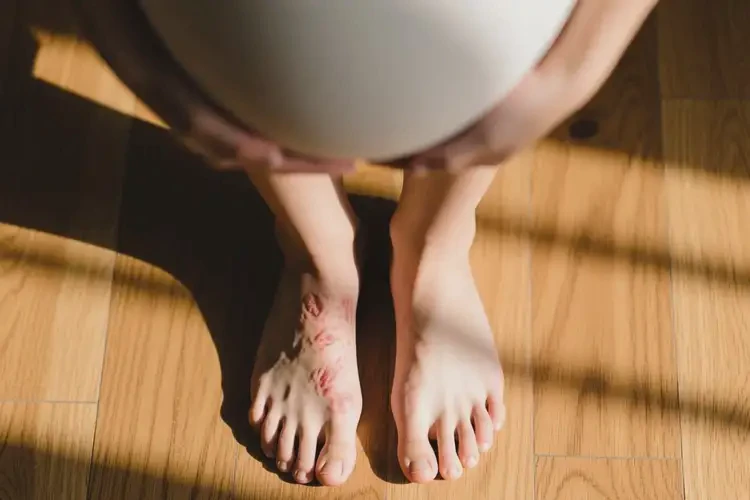 產(chǎn)婦腳上長(zhǎng)濕疹不管它會(huì)自己好嗎(圖2)