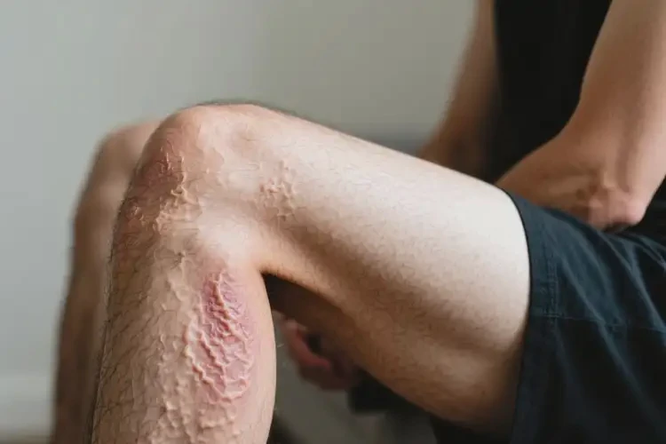 男性大腿上出現(xiàn)濕疹能徹底自愈嗎(圖3)