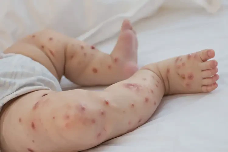 幼兒四肢偶爾起濕疹不管它會自己好嗎(圖4)