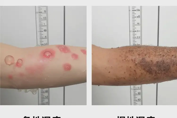 青年人屁股起湿疹可以彻底自愈吗(图3)