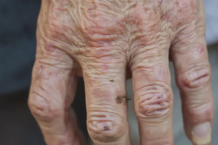 高齡老人手上經(jīng)常起濕疹不管它會(huì)自己痊愈嗎(圖4)