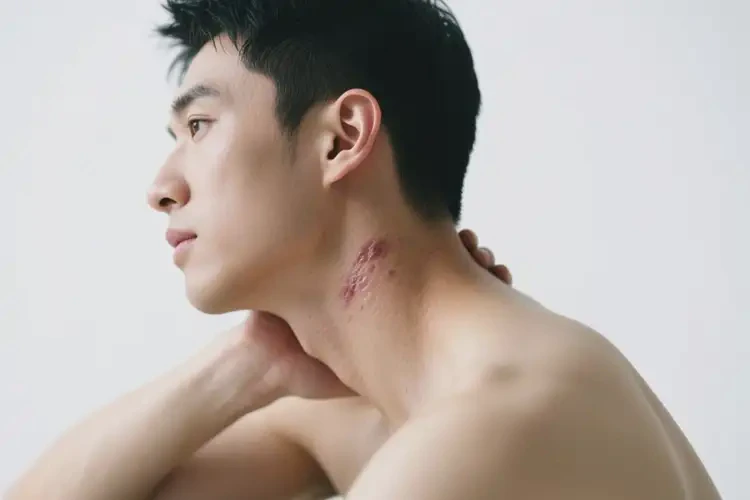 男性脖子起濕疹不管它會(huì)自己好嗎(圖3)
