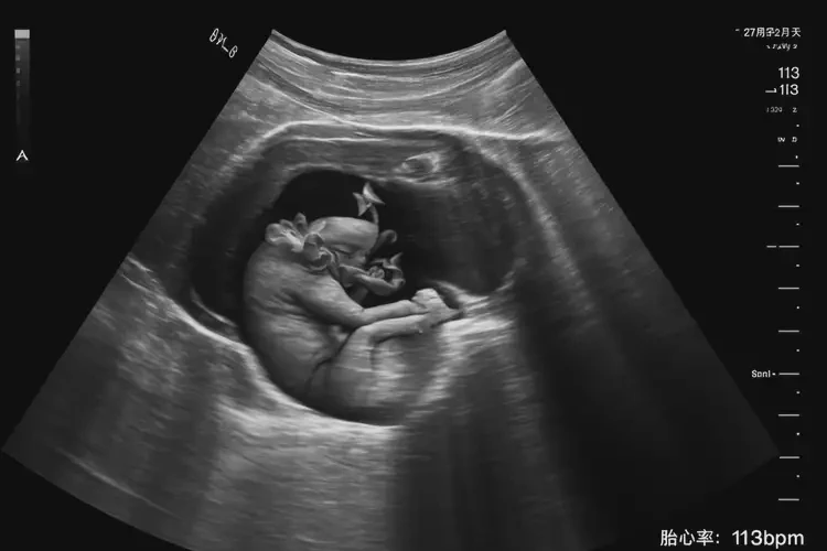 孕27周2天胎心113正常嗎(圖4)