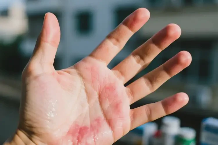 男生手上起濕疹能靠自己自愈嗎(圖1)