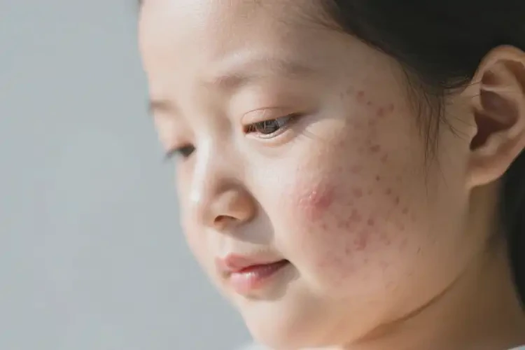 產(chǎn)婦面部偶爾起濕疹不管它會自己自愈嗎(圖2)