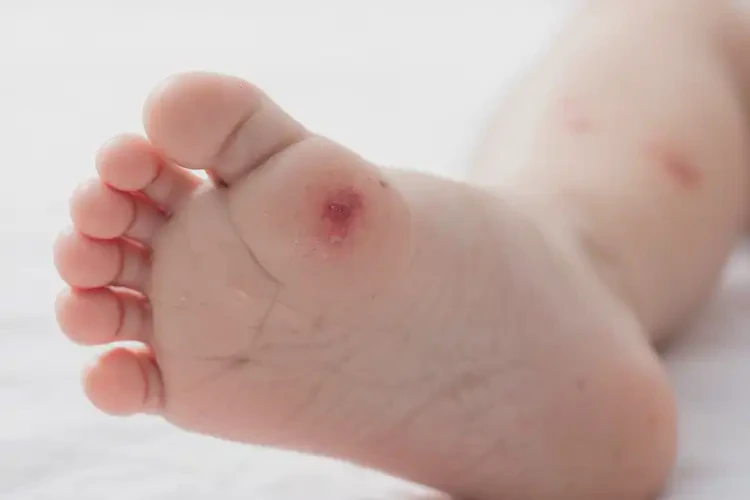 幼兒腳上長(zhǎng)濕疹不管它會(huì)自己好嗎(圖4)