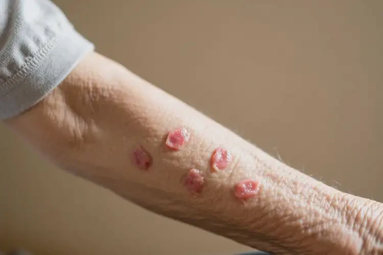 老人手臂上偶爾起濕疹可以徹底自愈嗎(圖1)