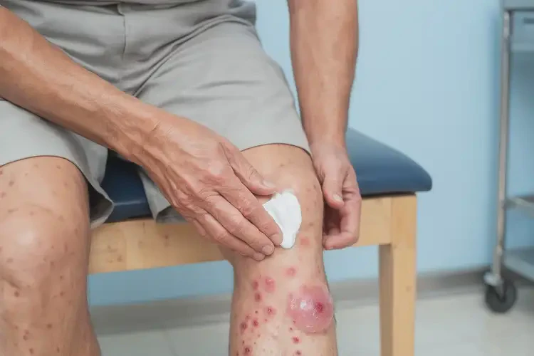 男人小腿經(jīng)常長濕疹不管它會自己自愈嗎(圖2)