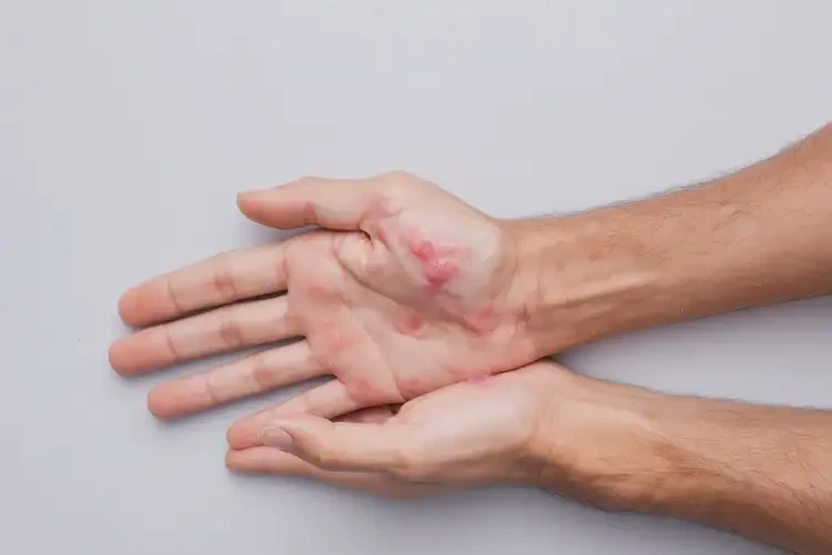 男生手上長濕疹不管它會自己自愈嗎(圖3)