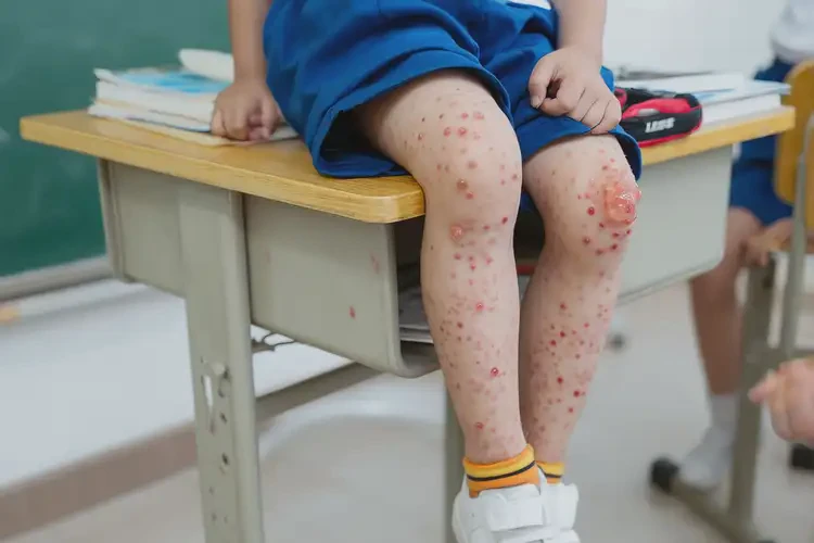 小學生小腿上出濕疹能徹底自愈嗎(圖3)