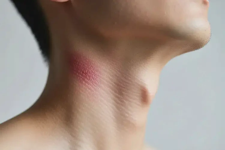 男性脖子上容易起濕疹能靠自己自愈嗎(圖4)
